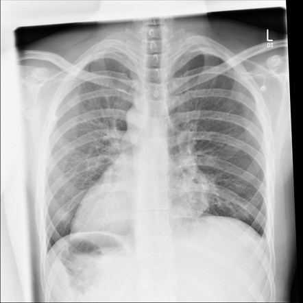 Viewing playlist: Favourite chest cases | Radiopaedia.org