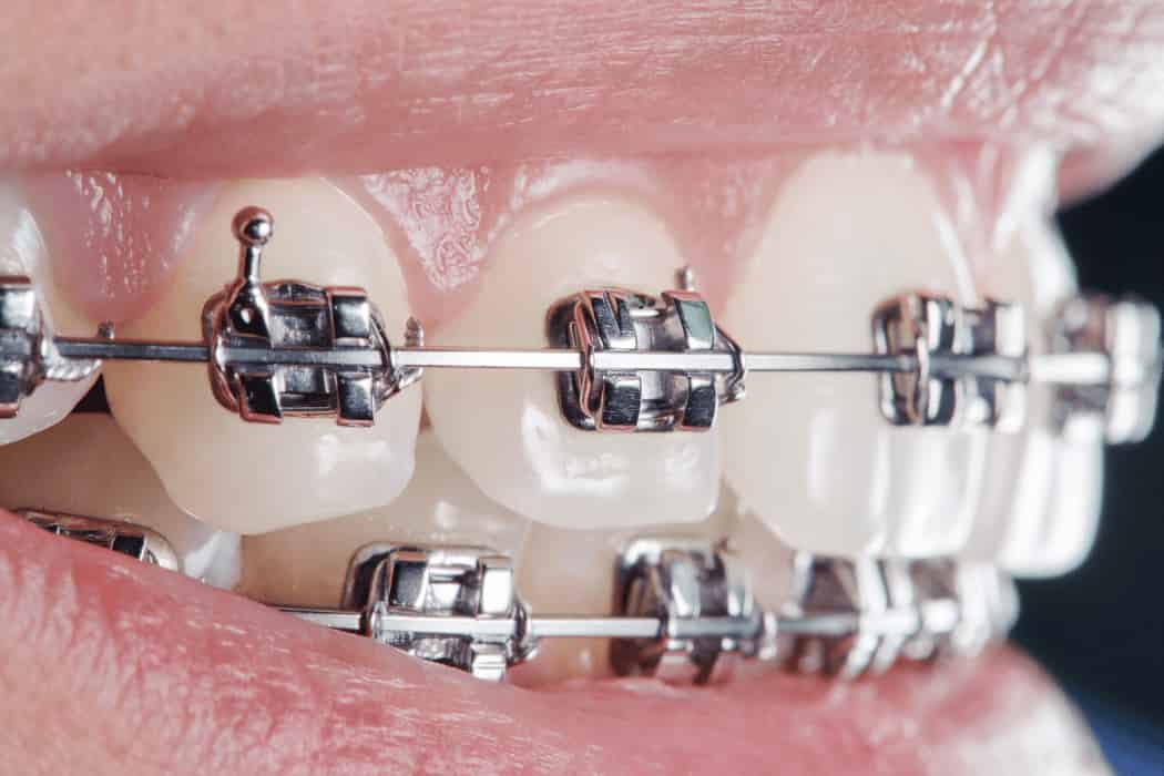 The Road to Confident Smile Exploring Dental Braces Options