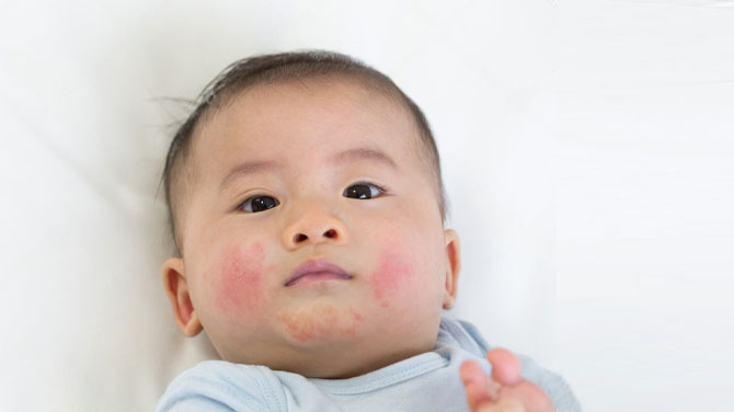 Diagnosis and Treatment: Navigating Baby Acne or Rash