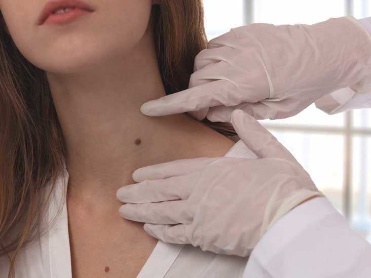 Finding the Right Mole Removal Treatment in Dubai