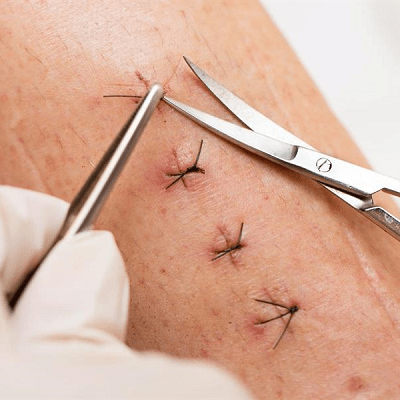 Suture Removal At Home in Dubai: A Step-by-Step Guide