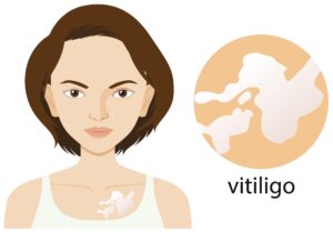 Vitiligo Treatment: Strategies & Emerging Therapies