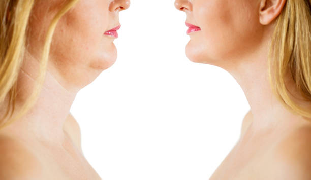Chin Liposuction in Abu Dhabi: What to Expect