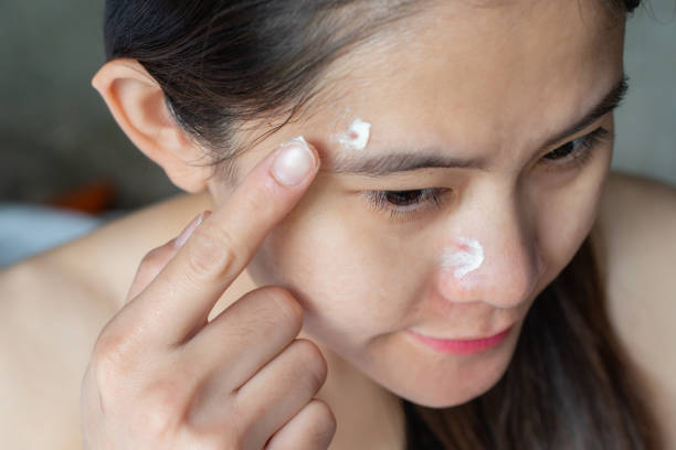 Skin Renewal: Expert Acne treatment in Abu Dhabi