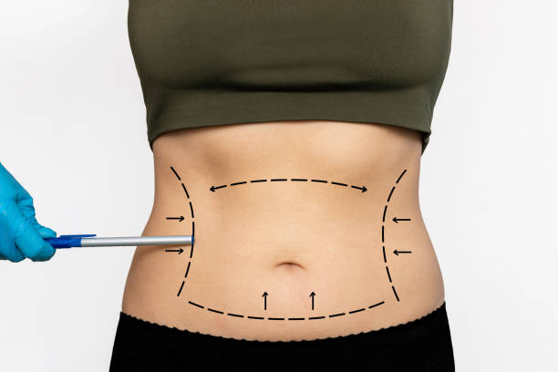 Transform Your Body: Liposuction in Abu Dhabi