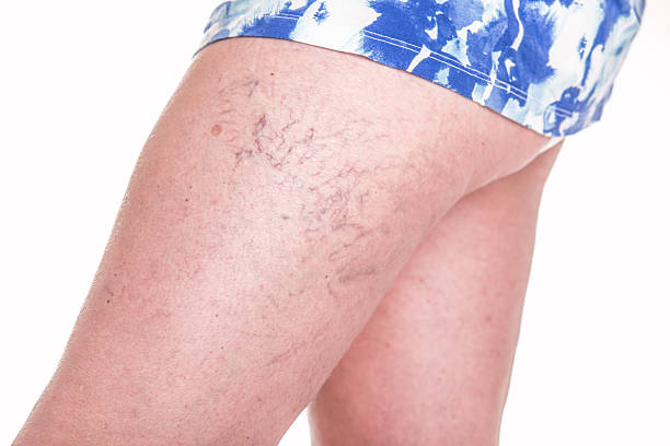 Spider Veins Treatment in Abu Dhabi: What to Expect