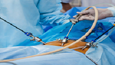 Advancements in Patient Care: Exploring Laparoscopic Surgery