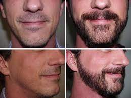 Beard Transplant UK: Your Path to Facial Hair Confidence