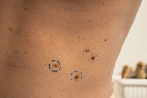 Understanding Laser Birthmark Removal: A Comprehensive Guide